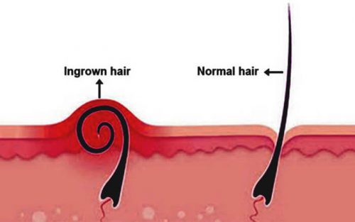 از بین بردن موهای زیر پوستی