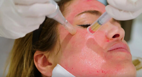 عوارض میکرودرم ابریژن